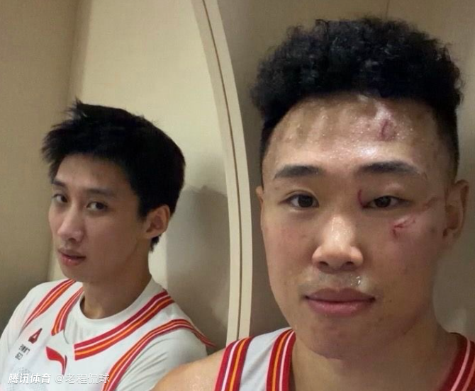 脸上被对手打出4道伤疤 贺希宁赛后照片触目惊心