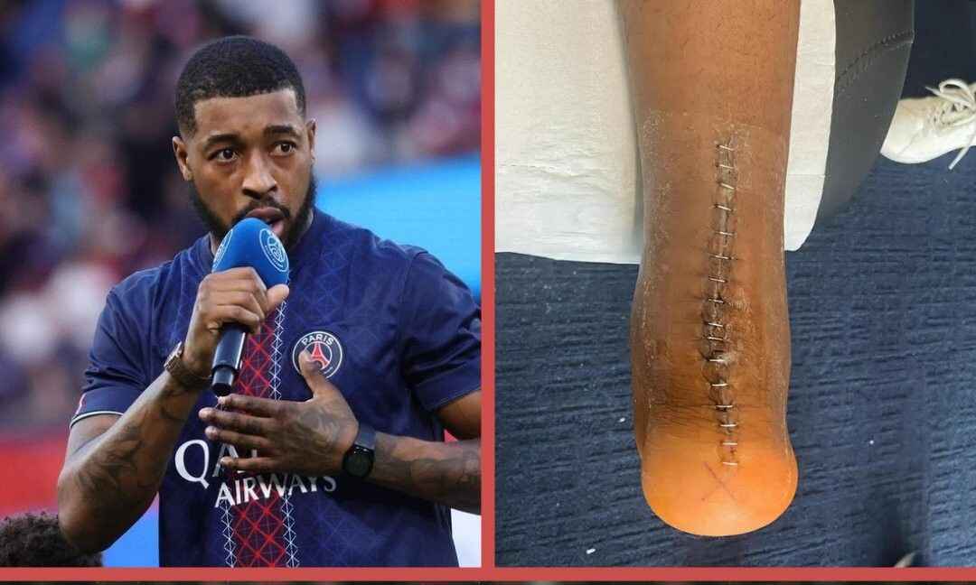 同病相怜！金彭贝昔日跟腱断裂，进行2次手术700天才复出