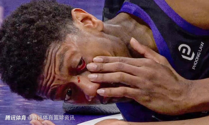 国王官方：亨特左眼睛受伤 对阵快船将不会回归