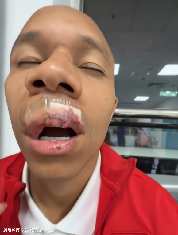 遭姜至鹏肘击！蓉城外援伤势严重：嘴唇缝15针+牙齿脱位，下轮或缺战