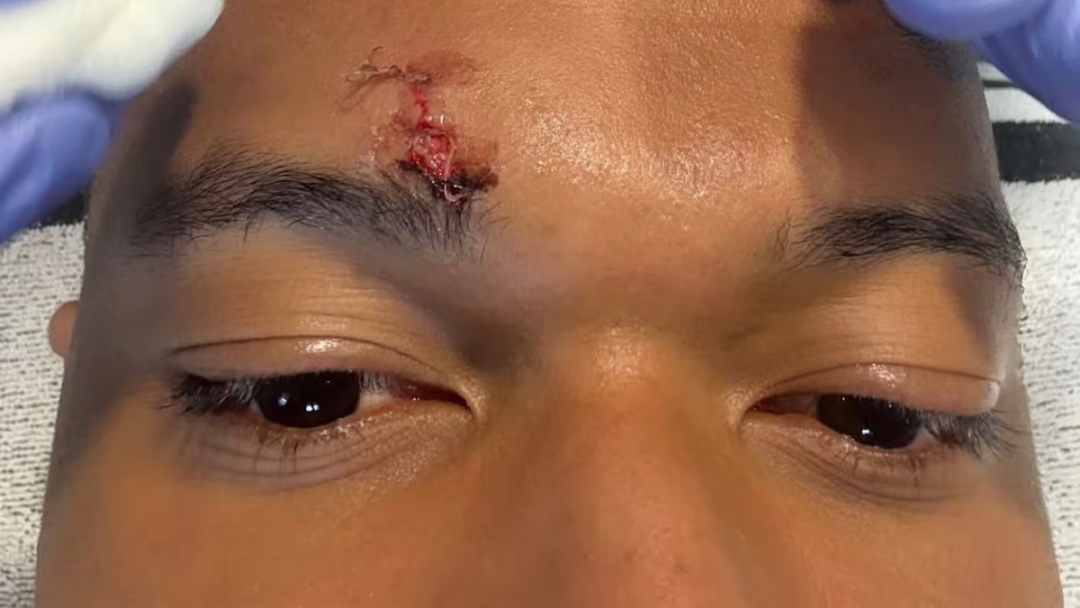 阿斯：姆巴佩眉骨缝三针，缺席训练但将配备防护措施出战拜仁