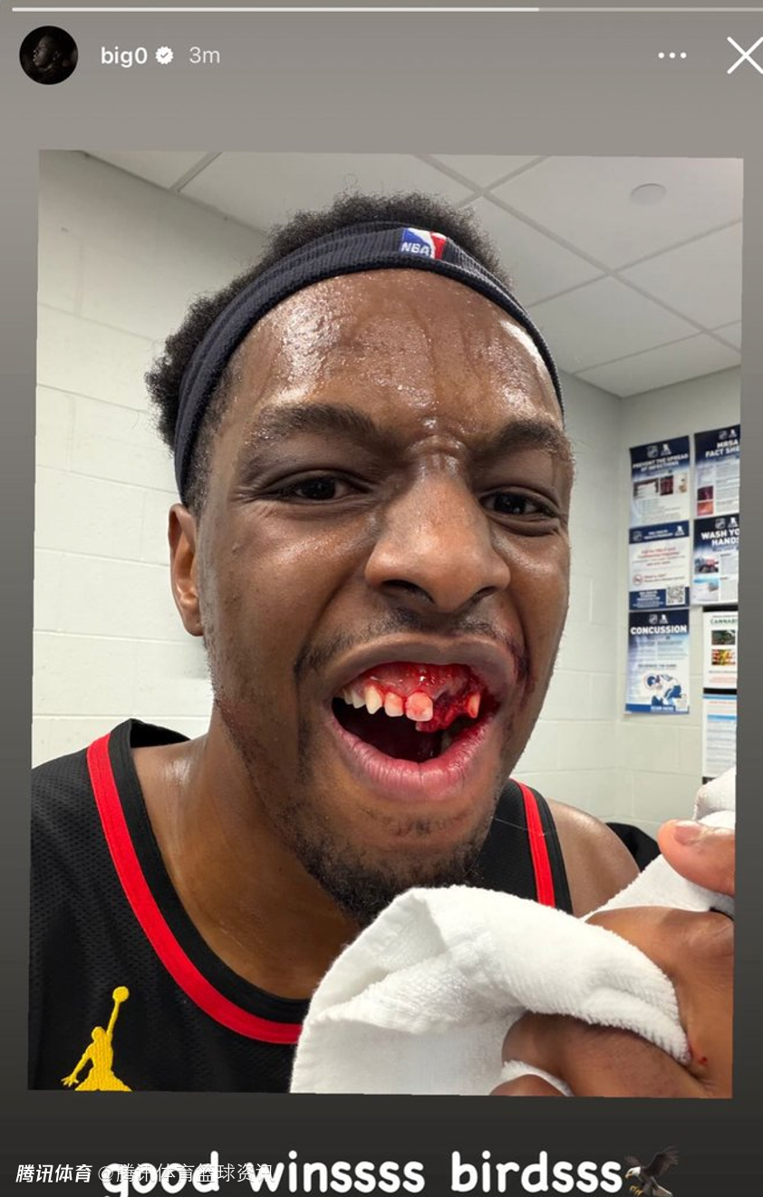 铁血硬汉！奥孔古社媒晒被杰伦-布朗肘击伤情 两颗牙齿被撞脱落